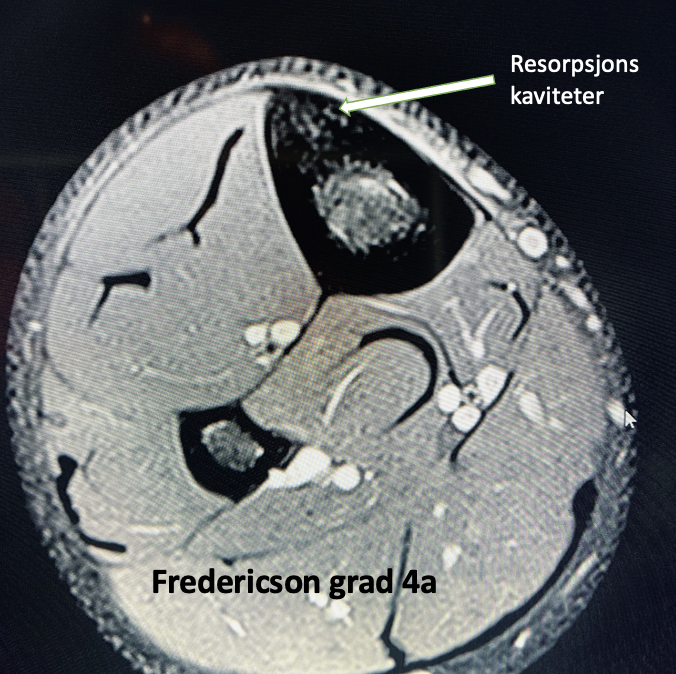 Stressreaksjon tibia 4a