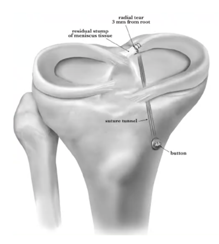 meniskrot transtibial fiksasjon, menisk skader