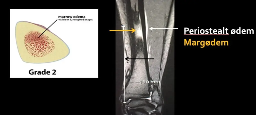 Hva er en stressreaksjon? beinmargsødem, stressreaksjon i tibia