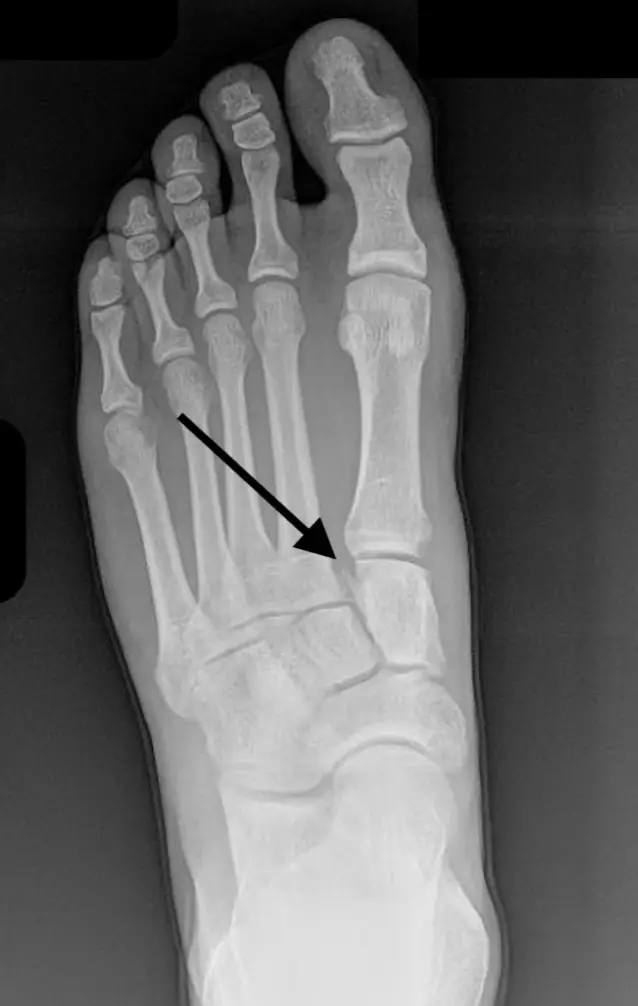 Lisfranc skade