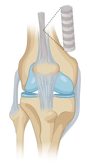 Quadriceps og patellarsenen, tendinopati