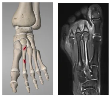 Stressreaksjon og tretthetsbrudd foten metatars