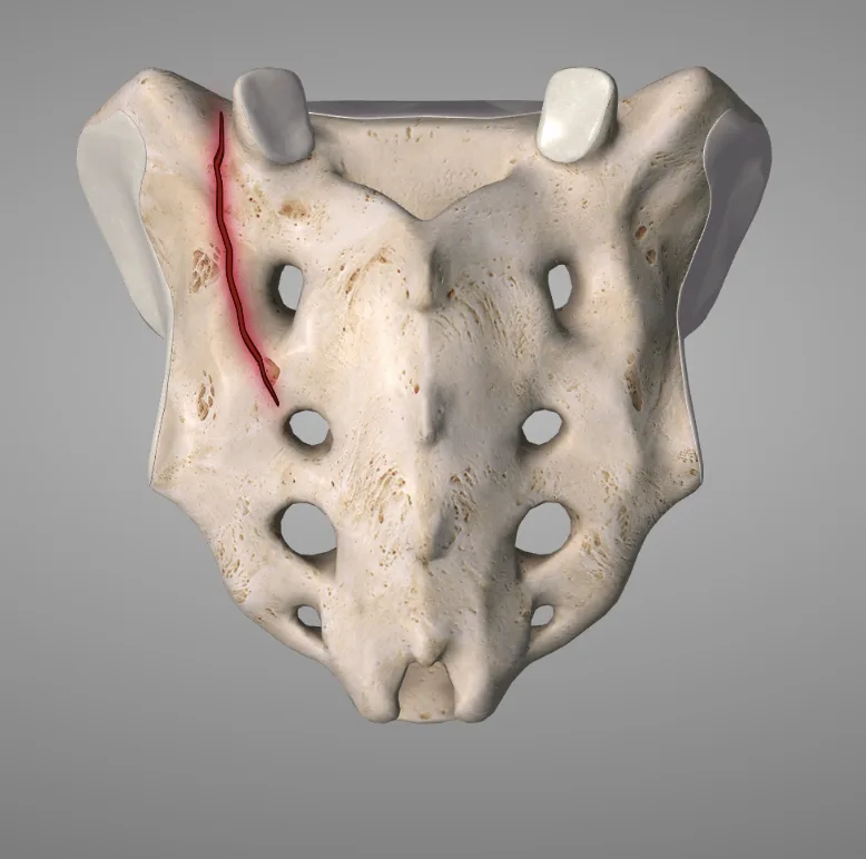 Stressreaksjon i sacrum, stressfraktur i sacrum, tretthetsbrudd korsbeinet